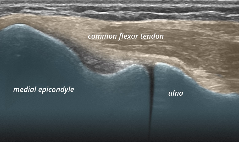 Elbow medial common flexor tendon longitudinal