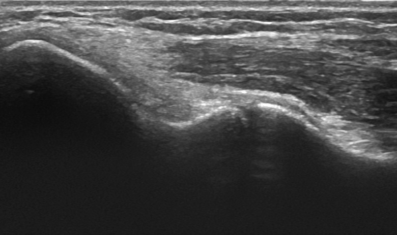 Elbow medial common flexor tendon longitudinal