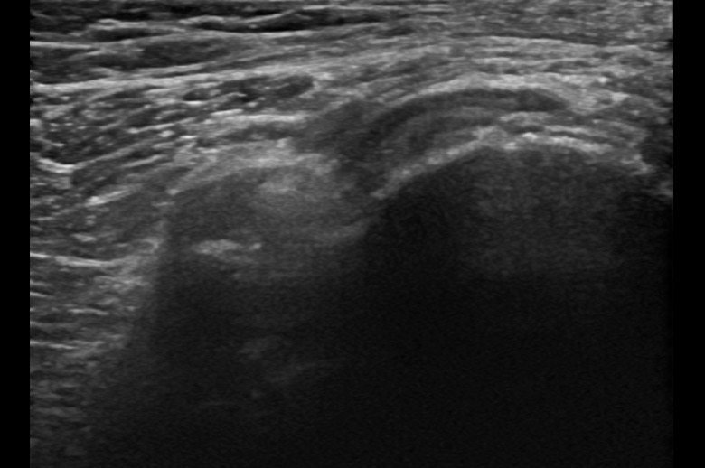 Pelvis posterior tuber ischiadicum hamstrings transverse