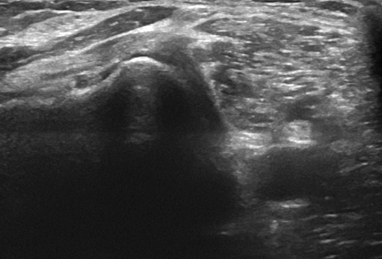Knee posterior lateral tendons popliteus transverse