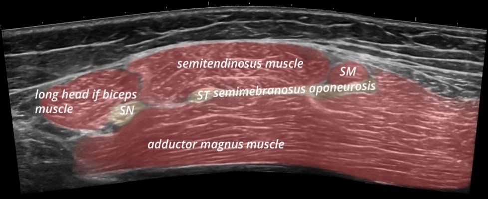 Pelvis posterior hamstrings transverse