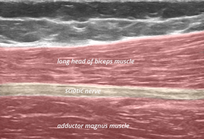 Pelvis posterior sciatic nerve longitudinal
