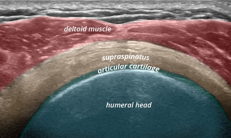 Shoulder anterior lateral supraspinatus transverse
