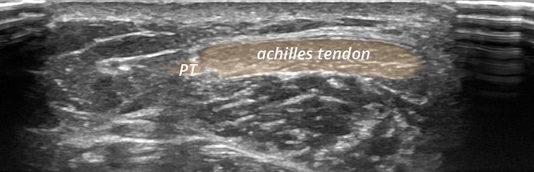Foot Ankle posterior achilles tendon transverse