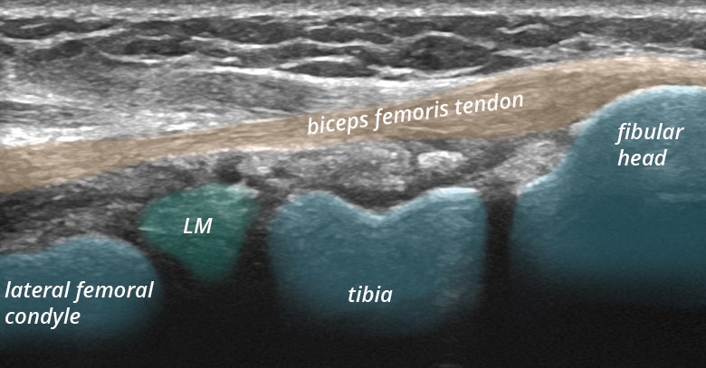 Knee posterior lateral tendons biceps longitudinal