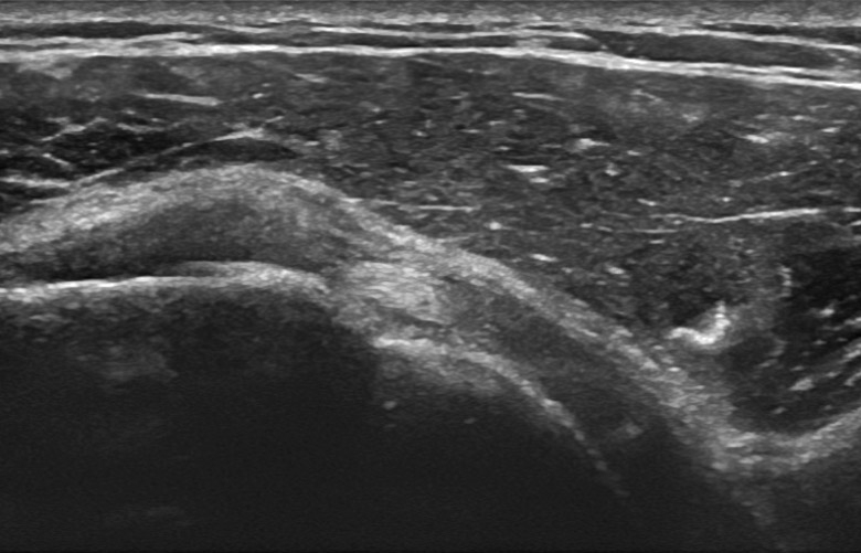 Shoulder antero-lateral interval