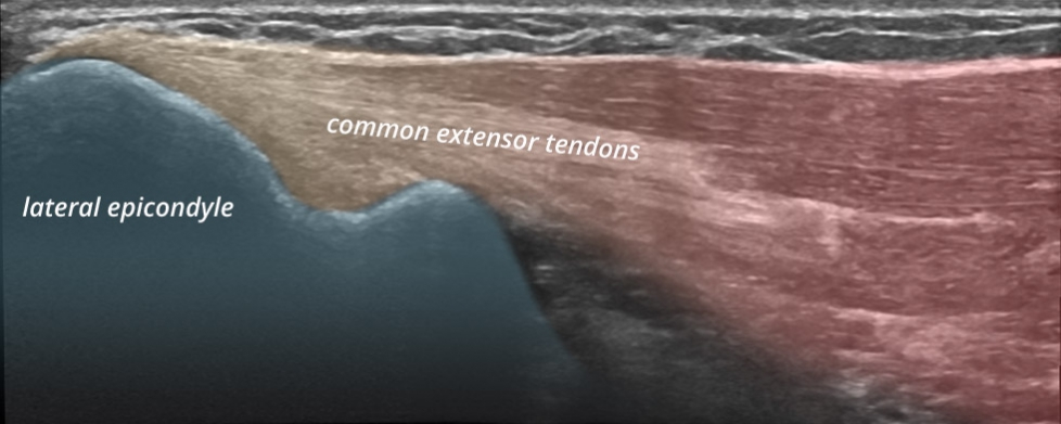Elbow lateral common extensor tendons longitudinal