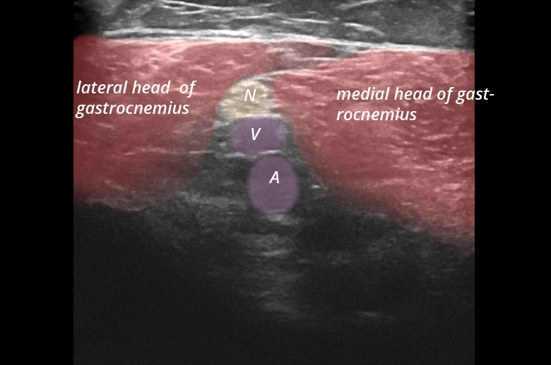 Knee posterior popliteal neurovascular bundle transverse