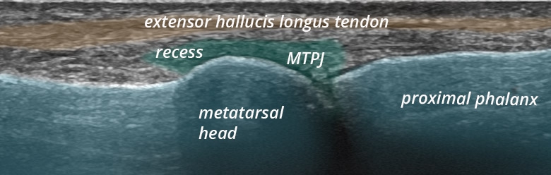 Foot Toes dorsal MTP 1 longitudinal