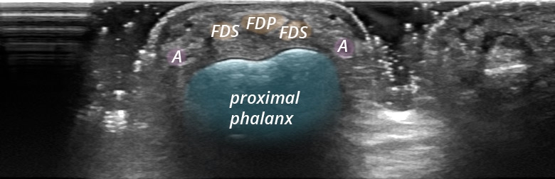 Hand fingers palmar digits I to V flexor tendons PIP transverse