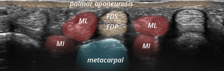 Hand fingers palmar digits I to V flexor tendons MCP transverse