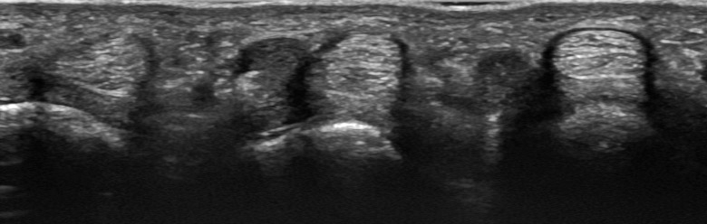 Hand fingers palmar digits I to V flexor tendons MCP transverse