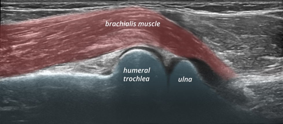 Elbow anterior humero ulnar longitudinal