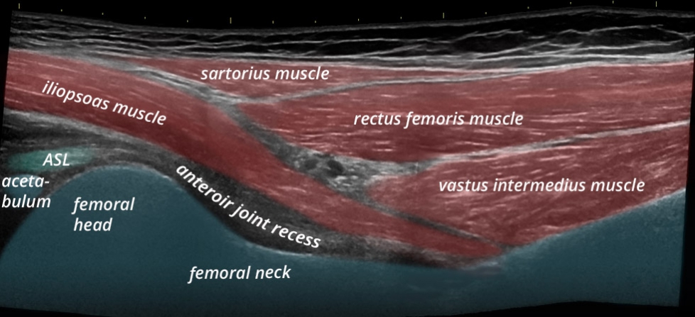 Pelvis anterior joint recess longitudinal