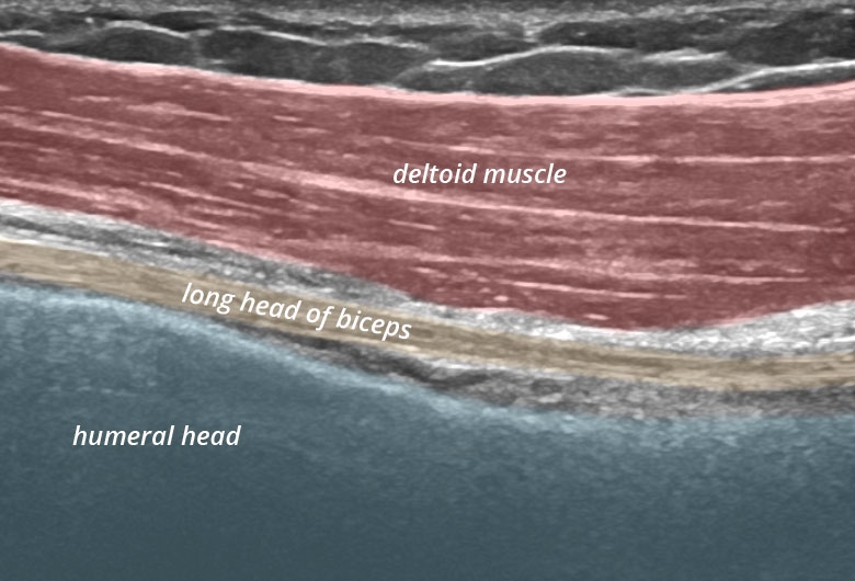Sonogram: Shoulder anterior biceps lh longitudinal