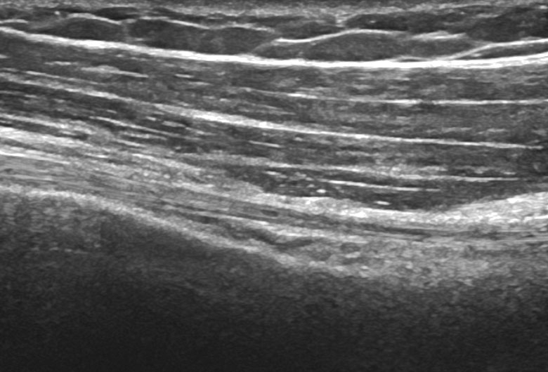 Sonogram: Shoulder anterior biceps lh longitudinal
