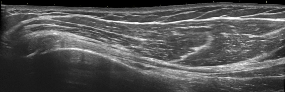 Sonogram: Shoulder anterior biceps lh longitudinal panorama