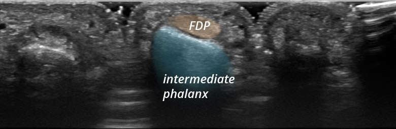 Hand fingers palmar digits I to V flexor tendons DIP transverse