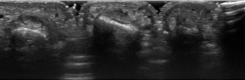 Hand fingers palmar digits I to V flexor tendons DIP transverse