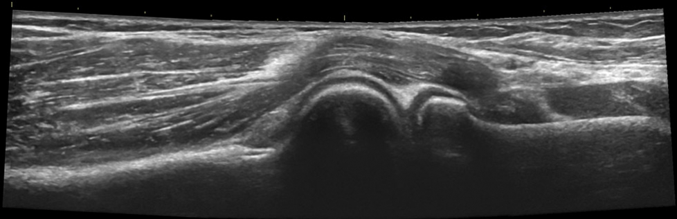 Elbow anterior humeroradial longitudinal