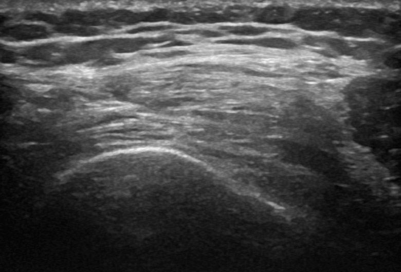 Knee anterior quadriceps tendon transverse