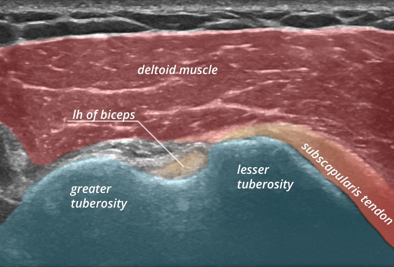 Sonogram: Shoulder anterior biceps lh transverse