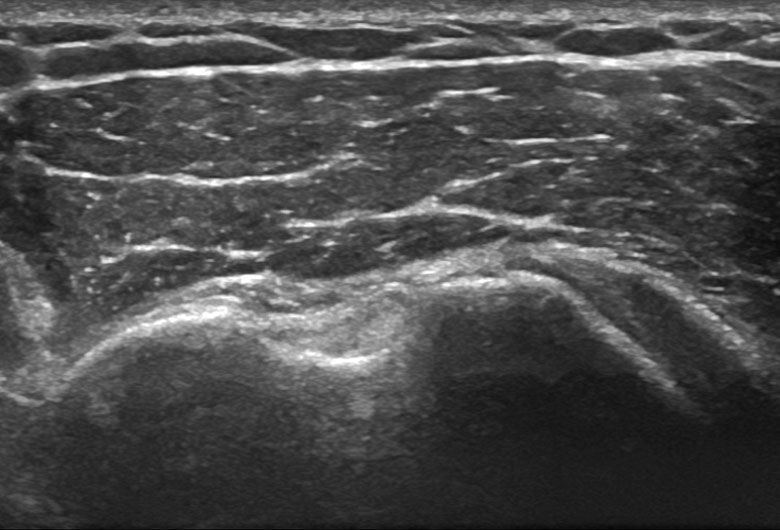 Sonogram: Shoulder anterior biceps lh transverse