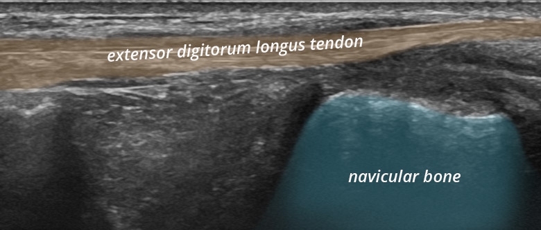 Foot Ankle anterior extensor tendons digitorum longus longitudinal