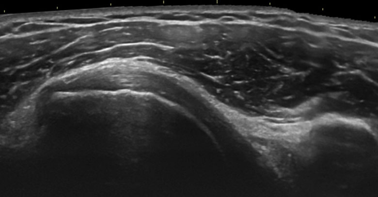 Shoulder anterior subscapularis longitudinal