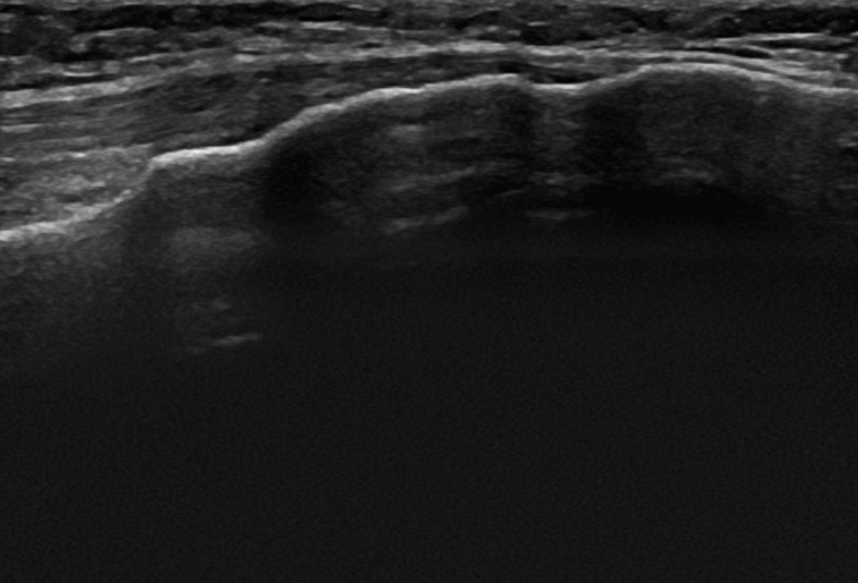 Knee anterior patellar tendon longitudinal