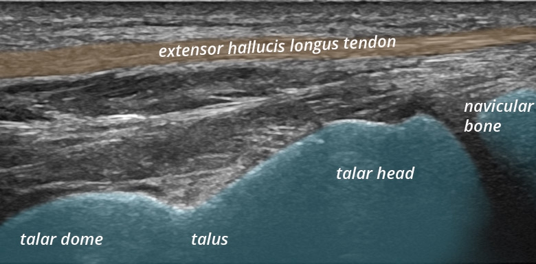 Foot Ankle anterior extensor tendons hallucis longus longitudinal