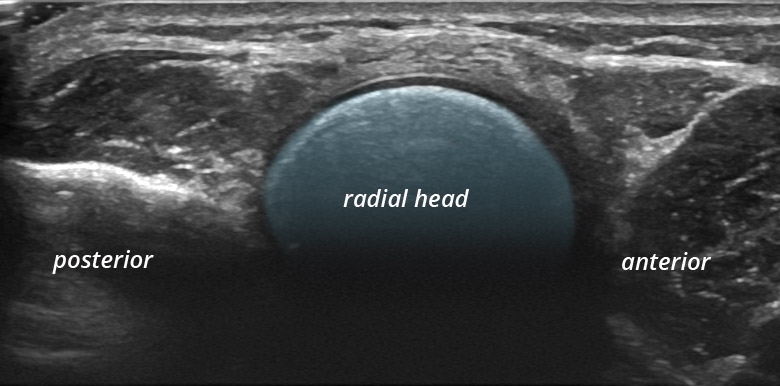 Elbow radial head transverse