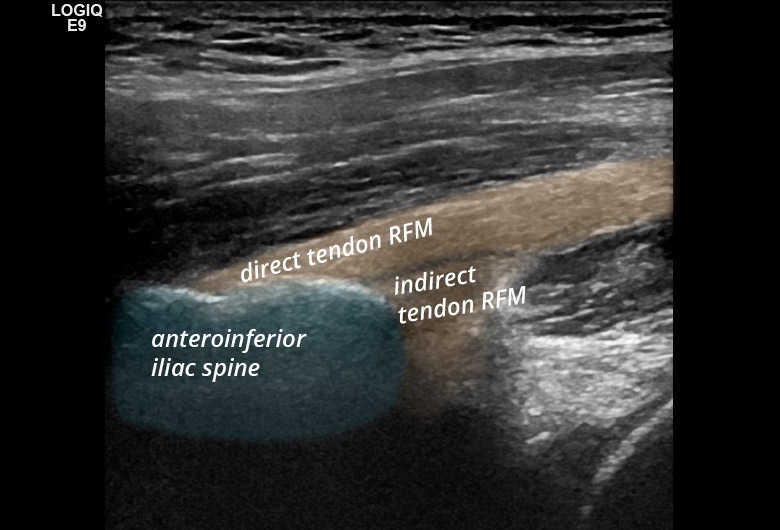 Pelvis anterior rectus femoris longitudinal