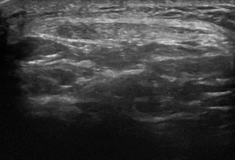 Knee anterior patellar tendon transverse