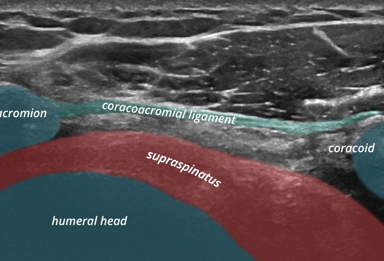 Sonogram: Shoulder anterior subscapularis transverse ligamentum coracoacromiale