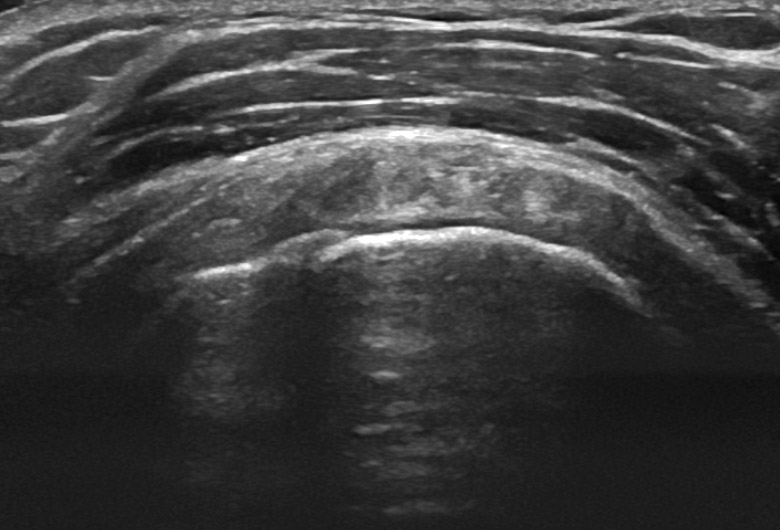 Sonogram: Shoulder anterior subscapularis transverse