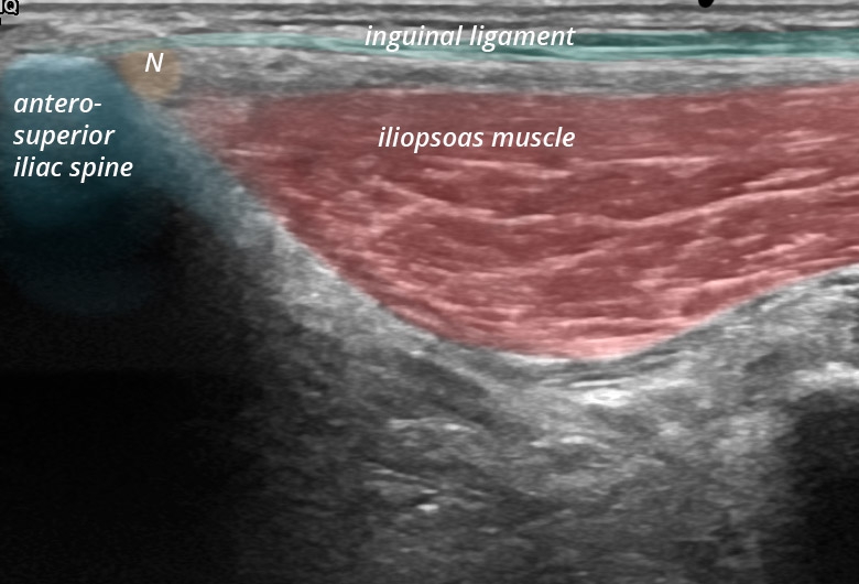 Pelvis anterior anterosuperior iliac spine femoral cutaneous nerve transverse