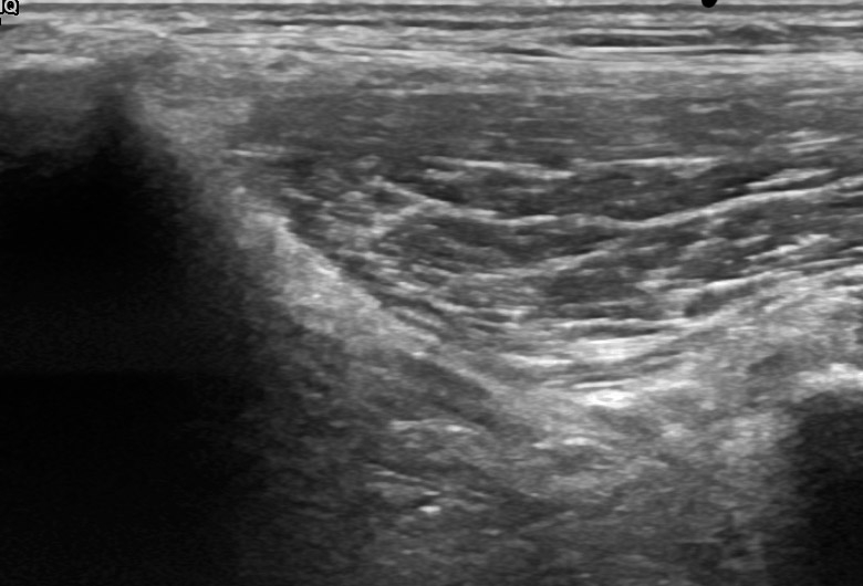 Pelvis anterior anterosuperior iliac spine femoral cutaneous nerve transverse