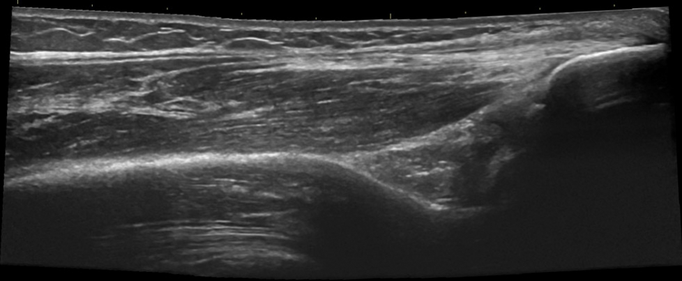 Elbow fossa olecrani triceps longitudinal
