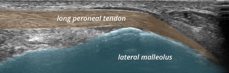 Foot Ankle lateral peroneal tendons longitudinal