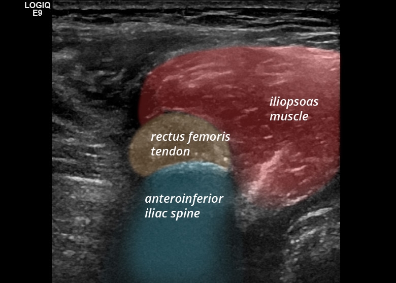 Pelvis anterior rectus femoris transverse