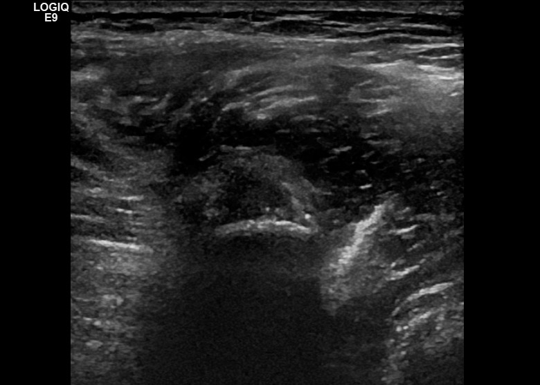 Pelvis anterior rectus femoris transverse