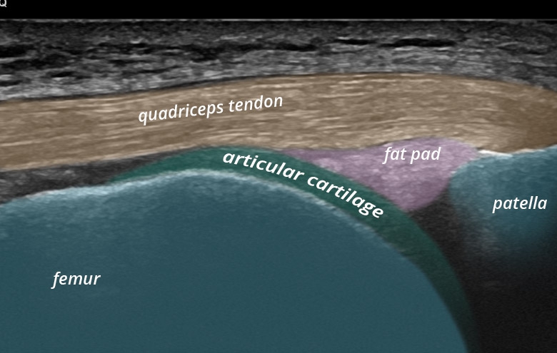 Knee anterior trochlea femoris quadriceps tendon knee flex transverse