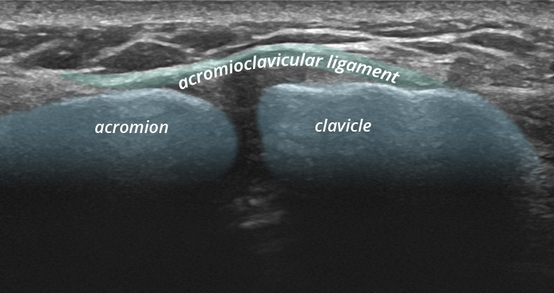 Sonogram: Shoulder superior acromioclavicular joint longitudinal