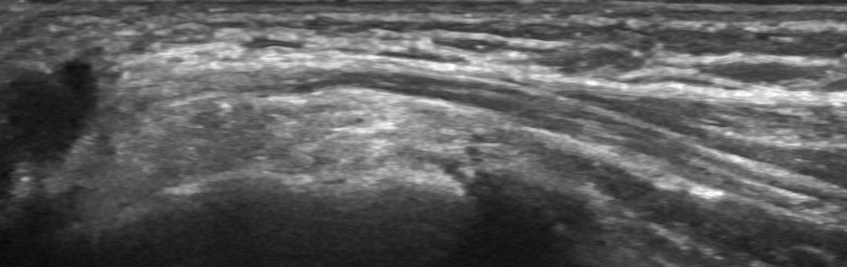Elbow posterior sulcus n ulnaris longitudinal