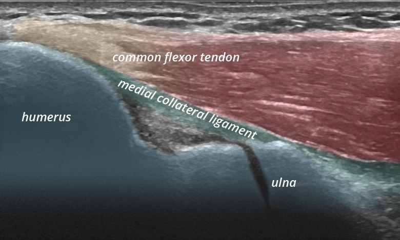 Elbow medial humero-ulnar medial epicondyle longitudinal