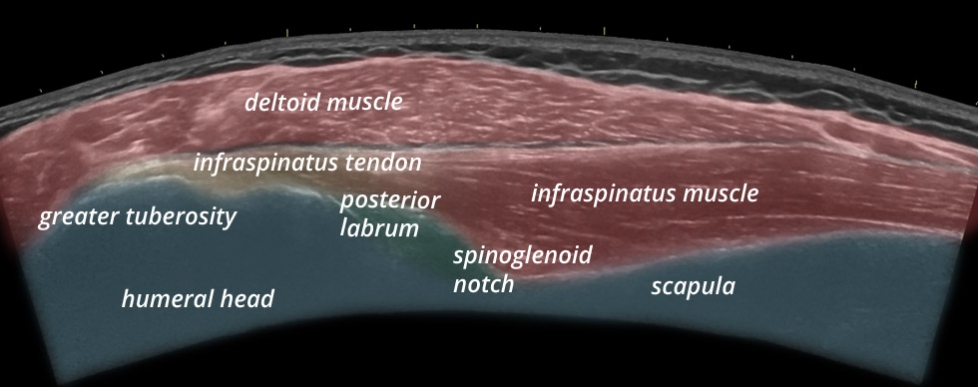 Sonogram: Shoulder posterior infraspinatus longitudinal