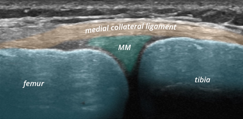 Knee medial collateral ligament longitudinal
