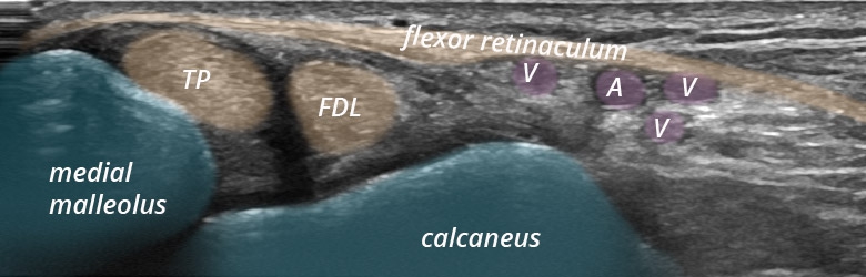 Foot Ankle medial flexor tendons transverse