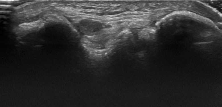 Elbow posterior sulcus n ulnaris transverse